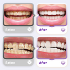 Brighten Your Teeth & Save More – Limited Deal! Lysozyme Brightening Stain-Removing Toothpaste