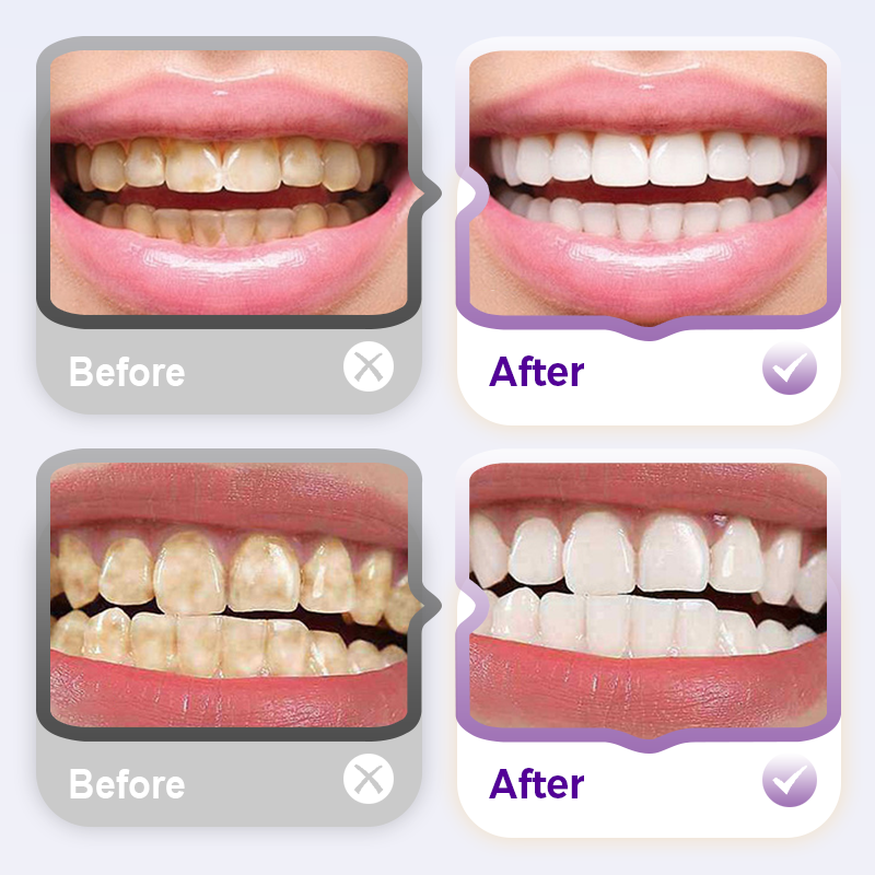 Brighten Your Teeth & Save More – Limited Deal! Lysozyme Brightening Stain-Removing Toothpaste